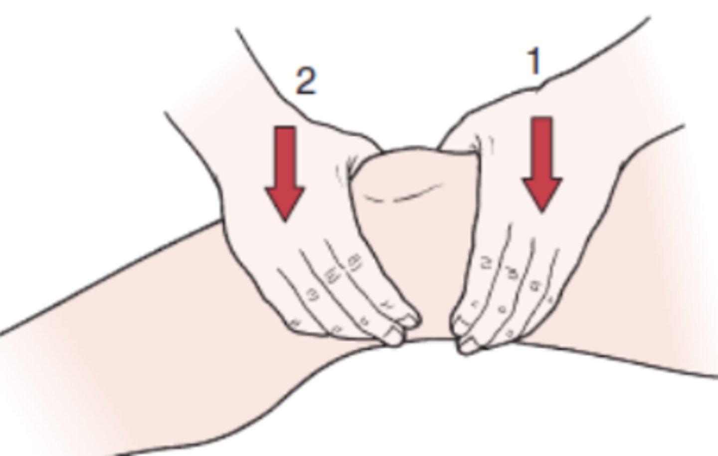 <p>- knee joint effusion</p><p>procedure:</p><p>- The examiner places the palm of one hand over the suprapatellar pouch and the palm of the other hand anterior to the joint with the thumb and index finger just beyond the margins of the patella</p><p>(+): By pressing down with one hand and then the other, the examiner may feel the synovial fluid fluctuate under the hands and move from one hand to the other, indicating significant effusion</p>