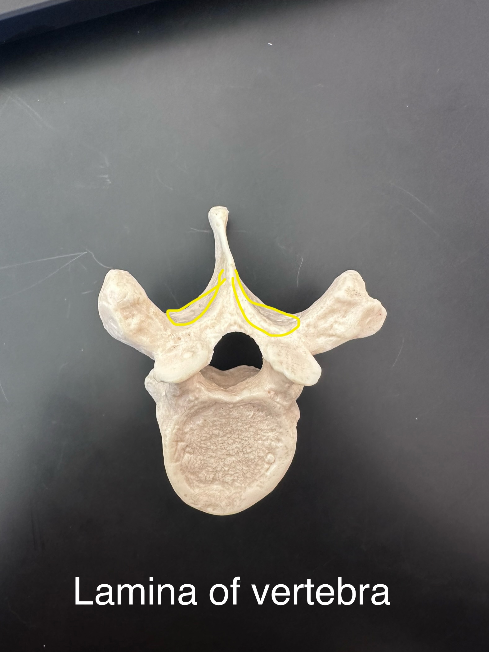 <p>Lamina of vertebra</p>