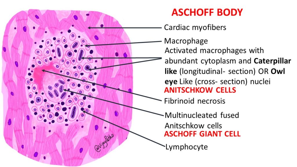 <p>a) Aschoff bodies</p><div data-type="horizontalRule"><hr></div><p><span>(</span><em>Granulomatous lesions with Anitschkow cells</em><span>)</span></p><p><span><mark data-color="#ffffff" style="background-color: #ffffff; color: inherit">Aschoff bodies are granulomatous lesions, specifically nodules, found in the heart tissue of individuals with rheumatic fever. </mark></span></p>