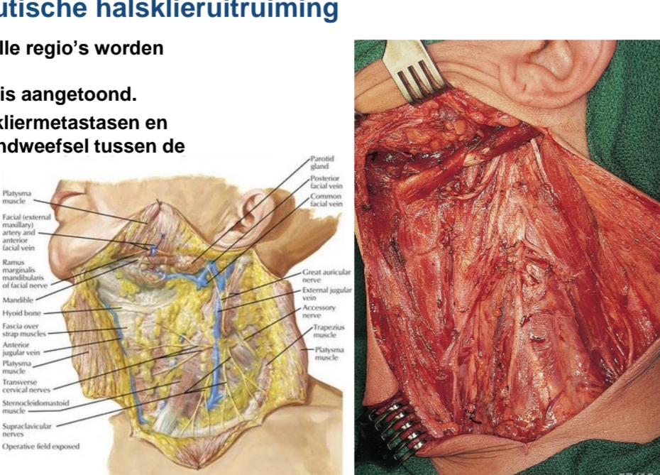 <p>In principe alle of bijna alle regio’s worden <br>weggenomen indien er <br>lymfekliermetastasering is aangetoond.<br>Wordt verwijderd: lymfekliermetastasen en <br>node bearing tissue = bindweefsel tussen de <br>organen (ook soms enkele zenuwen → bv accesorius, armmobiliteit boven de schouder, plexus cervicalis verdwijnt sowieso → sensibiliteit van hals en onerkant oor verdwijnt)<br></p><p>Verschillende types<br>Radicaal<br>Radicaal gemodifieerd<br>Selectief</p>