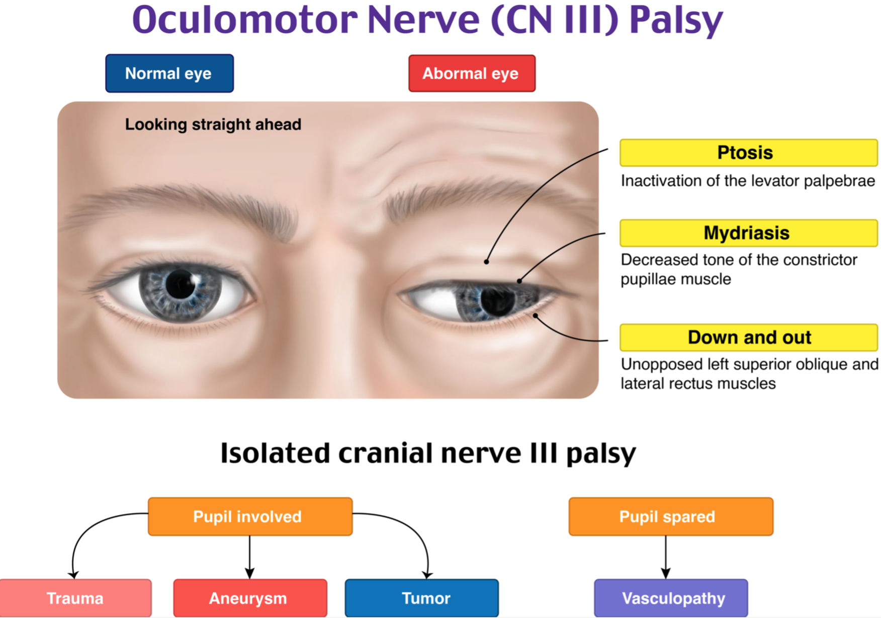 <p>PP: large pupil+ptosis+lateral deviation of eye</p><p>E: CN III damage of levator palpebrae muscle</p><p>CM: lateral deviation of eye down+out<br>ptosis of upper eyelid</p>