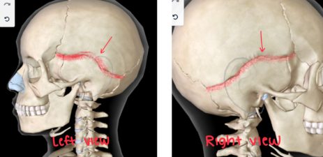 <p>DIVIDES the PARIETAL and TEMPORAL BONES </p><p></p>