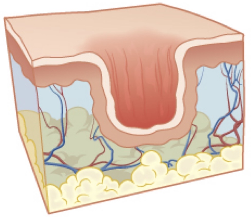 <p>Break in the skin or open sore</p><p>Often involve deep layers of skin</p>