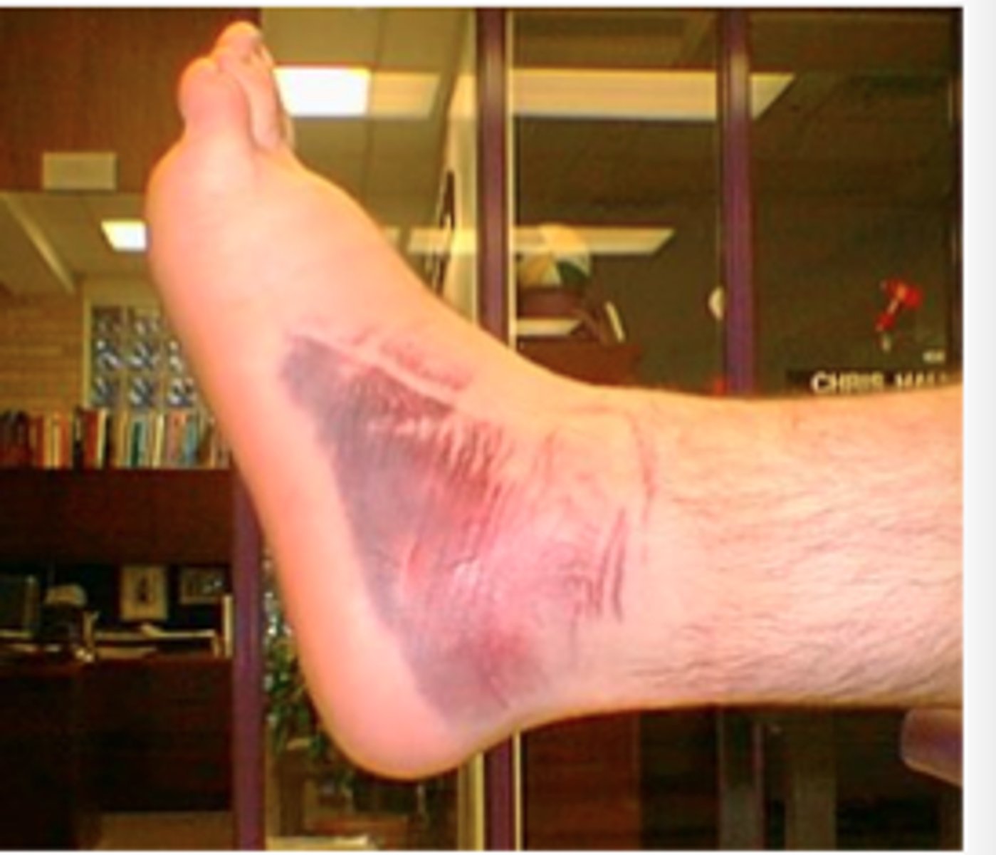 <p>AKA bruise or contusion; flat area of discolored skin</p>