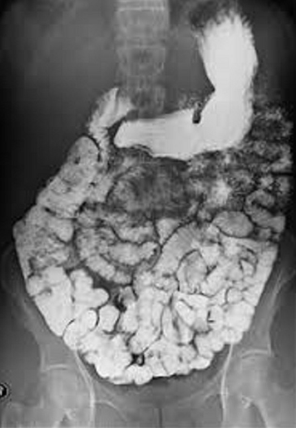 <p>1)contrast procedure performed? </p><p>2)contrast media used? </p><p>3)motility study means__? </p><p>4)Why is this examination done at different time intervals?</p>