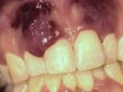 <p>What is kaposi’s sarcoma?</p>