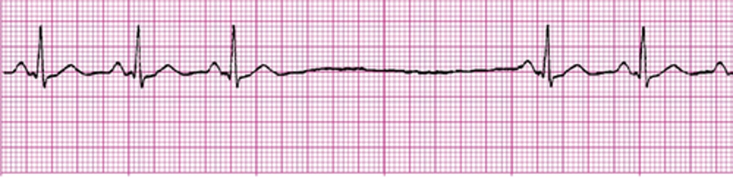 <p>Sinus arrest</p>