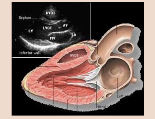<p><span style="color: #000000">The aim in this view is to orientate the beam with the long axis of the left ventricle (LV).</span><span style="color: #000000"><br></span><span style="color: #000000">• The transducer is placed to left of the sternum in the 3rd, 4th, or 5th intercostal space with the</span><span style="color: #000000"><br></span><span style="color: #000000">transducer indicator orientated towards the right clavicle (approximately 11 o’clock).</span><span style="color: #000000"><br></span><span style="color: #000000">• PLAX allows for excellent images of the right ventricle (RV), left atrium, left ventricle, mitral valve, aortic valve, aortic root, aortic outflow tract, and the surrounding pericardium.</span></p>