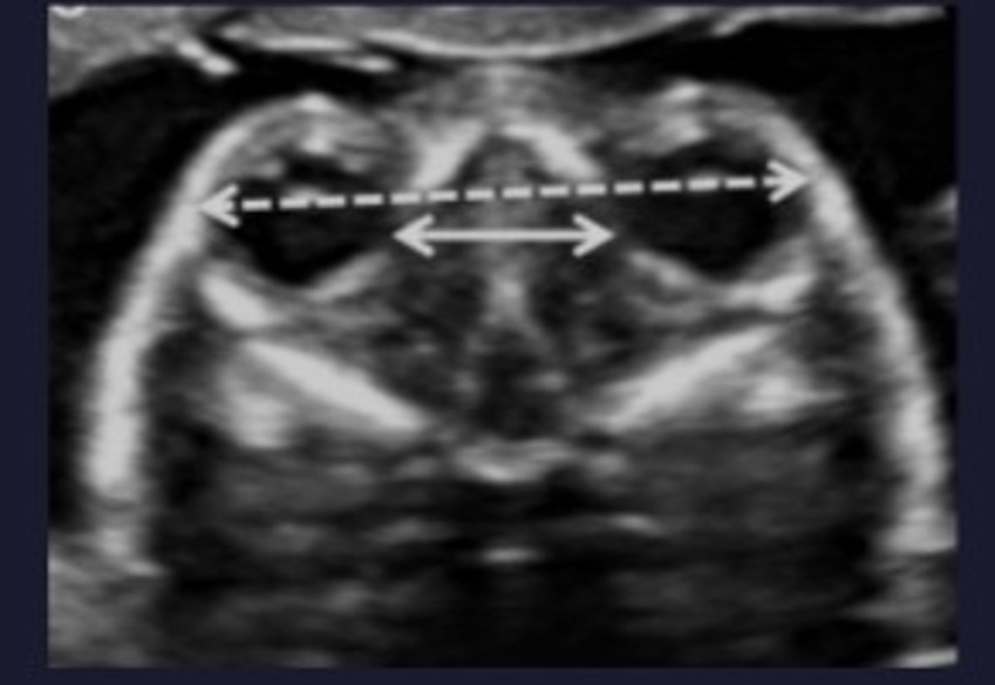 <p>25-35 mm (between medial orbital walls).</p>