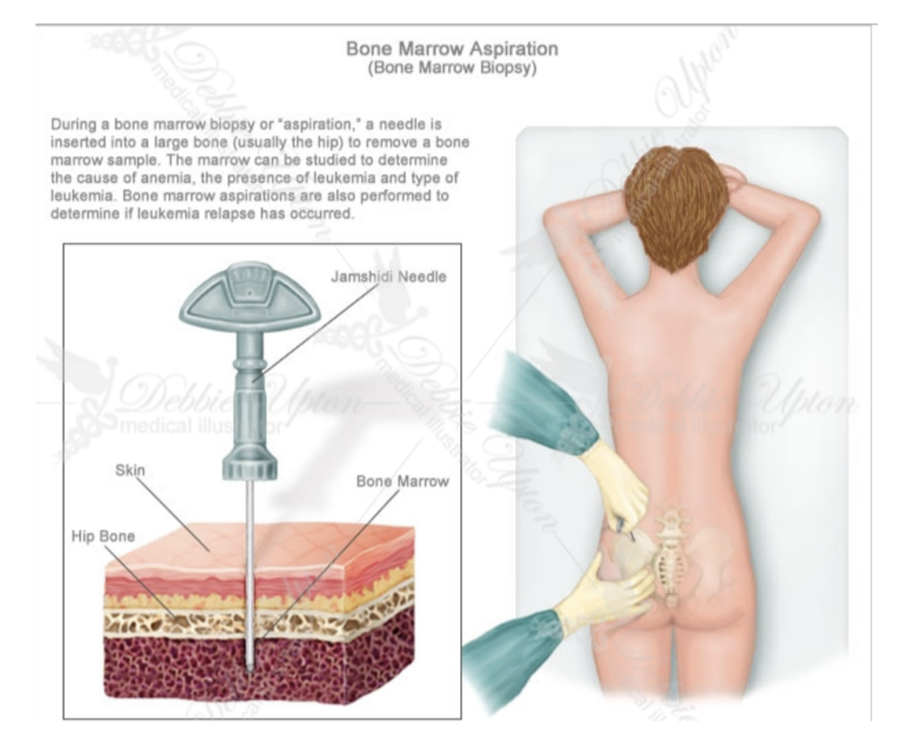<ul><li><p>In certain diseases (ex. leukemia), a sample of bone marrow must be obtained to assess the stage &amp; severity of the problem — often the iliac crest is used as it lies close to the surface &amp; is easily palpated</p></li><li><p>The procedure is performed by injecting anesthetic in the skin &amp; passing a cutting needle through the cortical bone of the iliac crest, where the bone marrow is then aspirated &amp; viewed under a microscope</p></li><li><p>Samples of cortical bone can also be obtained in this way to provide information about bone metabolism</p></li></ul>