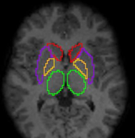<p>seen in purple</p>