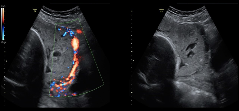 <p>which is described as <strong>invasion</strong> of the placental <strong>chorionic villus</strong> “<strong>deep”</strong> into the uterine <strong>myometrium</strong></p><p>.</p><p>a) placenta increta</p><p>b) placenta percreta</p><p>c) placenta accreta</p><p>d) placenta myocreta</p>