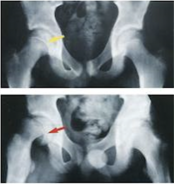 <p>what is the exact cause of slipped capital femoral epiphysis? </p><p>what 2 factors are likely?</p>