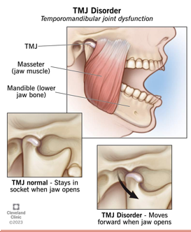 <ul><li><p>temporomandibular disorder</p></li><li><p>joint tenderness, neck/shoulder pain from tension, chronic headaches&nbsp;</p></li></ul><p></p>
