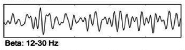 <p>What does this EEG show?</p>