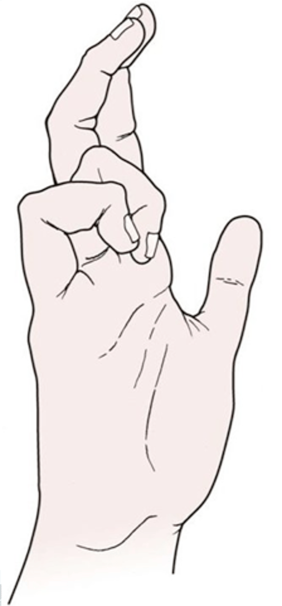 <p>wasting of the hypothenar muscles of the hand, interossei ms and 2 medial lumbricals due to ULNAR nerve palsy</p><p>**hyperextension of MCP joint and flexion of IP joint</p>