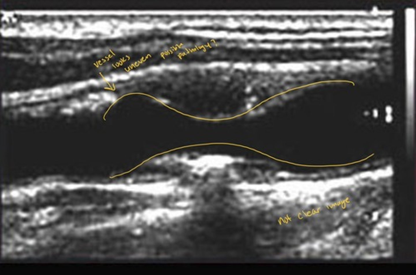 <p>Refers to an uneven echo pattern or reflection of varying gray scale, not uniform and texture or composition.</p><p>image comes out looking patchy, mixed or irregular often indicates in need for further investigation</p>