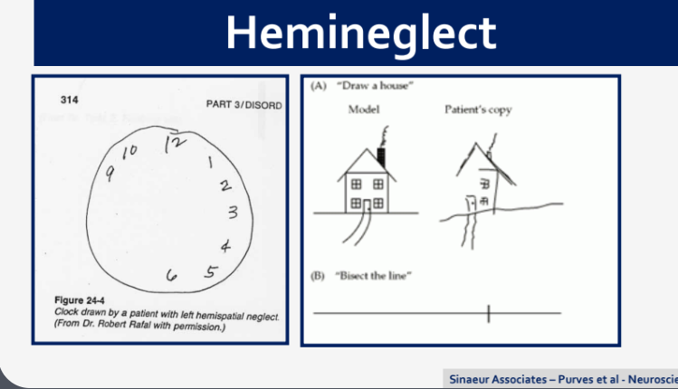 <p>Hemineglect is a neurological condition characterized by a lack of awareness or attention to one side of space, often occurring after damage to the right parietal lobe. </p>