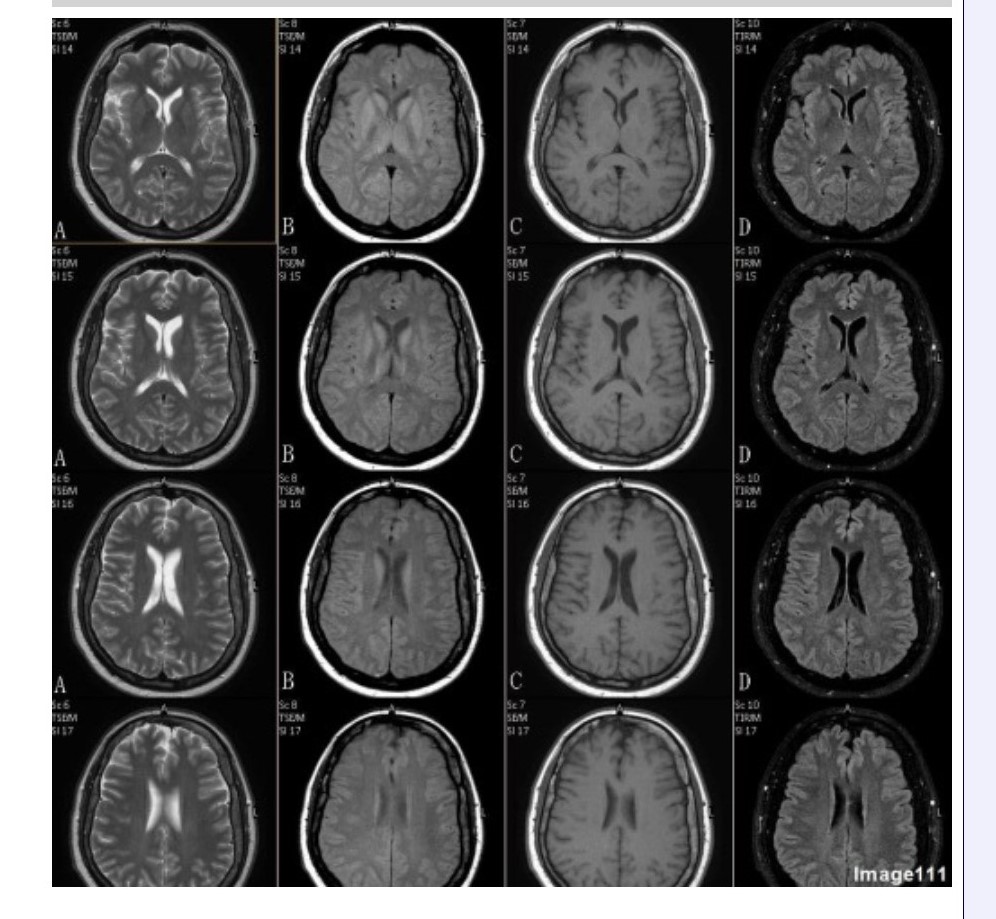 <p><span>&nbsp;Column C in Image 111 corresponds to which MRI pulse sequence?</span></p><p><span>&nbsp;A. Proton density</span></p><p><span>&nbsp;B. T1 weighted</span></p><p><span>&nbsp;C. T2 weighted</span></p><p><span>&nbsp;D. T2 FLAIR</span></p><p><span>&nbsp;E. T2 weighted with fat suppression</span></p><p><span>&nbsp;F. T2* gradient echo</span></p>