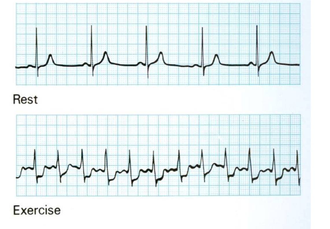 Pesence of underlying coronary artery disease, & further diagnostic testing may be required to evaluate the severity of the disease.
