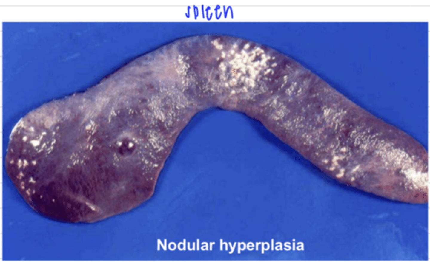 <p>hyperplasia</p>