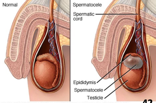 <ul><li><p><strong>Painless, sperm-containing cyst</strong> that forms at the end of the epididymis</p><ul><li><p class="p2">May be difficult to distinguish from hydrocele, but aspirated fluid from spermatocele contains spermatozoa</p></li></ul></li></ul><p></p>