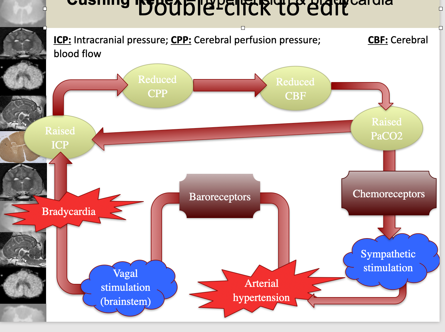<p>Is the hypertension and bradycardia that is caused by INCREASED INTRACRANIAL PRESSURE on the brainstem</p><ul><li><p>This is why you monitor a patient’s blood pressure if they have any sort of brain swelling&nbsp;</p></li></ul><p></p>