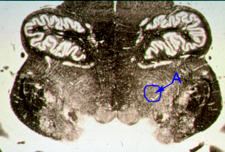 <p>Identify the structure indicated by the outline and letter "A".</p><p><span>A. Dorsal motor nucleus of the vagus</span></p><p><span>B. Anterolateral system</span></p><p><span>C. Spinal trigeminal nucleus</span></p><p><span>D. Medial lemniscus</span></p><p><span>E. Nucleus ambiguous</span></p><p></p>