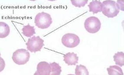 <ul><li><p>crenated cells</p></li><li><p>numerous short, evenly spaced surface projections</p><ul><li><p>uniform size &amp; shape</p></li></ul></li><li><p>can be due to slow drying/prolonged storage</p></li><li><p>seen with renal dz &amp; lymphosarcoma in dogs</p></li></ul><p></p>