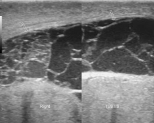 <p>sono appearance of pyocele </p>