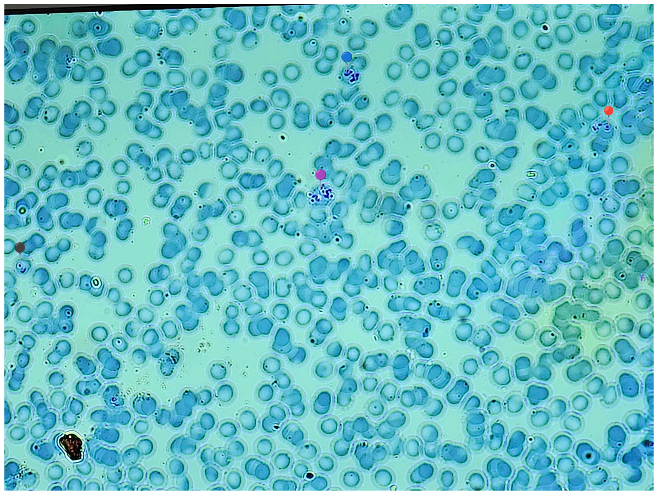 <p><strong><em>Plasmodium sp.</em></strong></p><p><span data-name="blue_circle" data-type="emoji">🔵</span><span data-name="purple_circle" data-type="emoji">🟣</span> - schizont segmenter;</p><p><span data-name="red_circle" data-type="emoji">🔴</span><span>️ - stadium pierścienia.</span></p><p></p><p></p><p><strong><span>Parazytoza:</span></strong><em><span> Malaria</span></em></p>