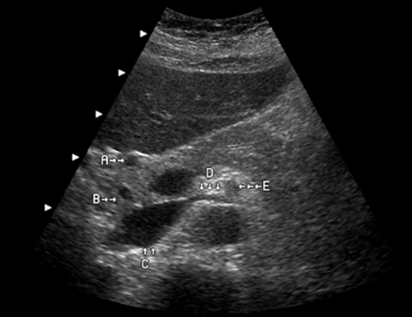 <p>What vessel is seen posterior to the vessel labeled D?</p><p>a. IVC</p><p>b. aorta</p><p>c. right renal artery</p><p>d. IMV</p><p>e. splenic vein</p>