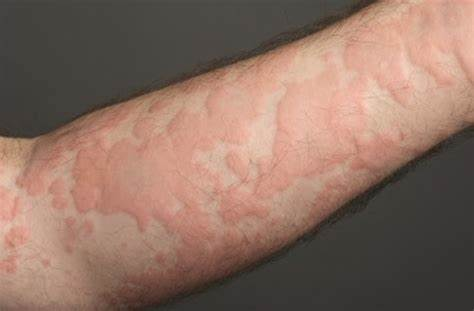 <p>This rash is called urticaria or hives. What disease is this associated with? </p><p>a. Mononucleosis</p><p>b. Chicken Pox</p><p>c. Rubella</p><p>d. Measles</p>