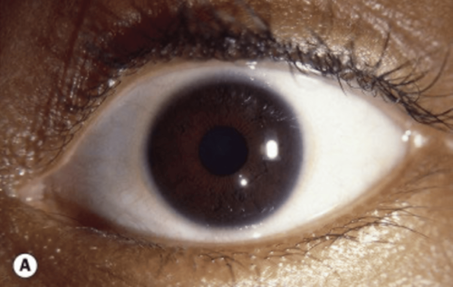 <p>1. glaucoma</p><p>2. congenital cataract</p><p>3. coloboma</p><p>4. optic nerve hypoplasia</p><p>5. aniridia</p>