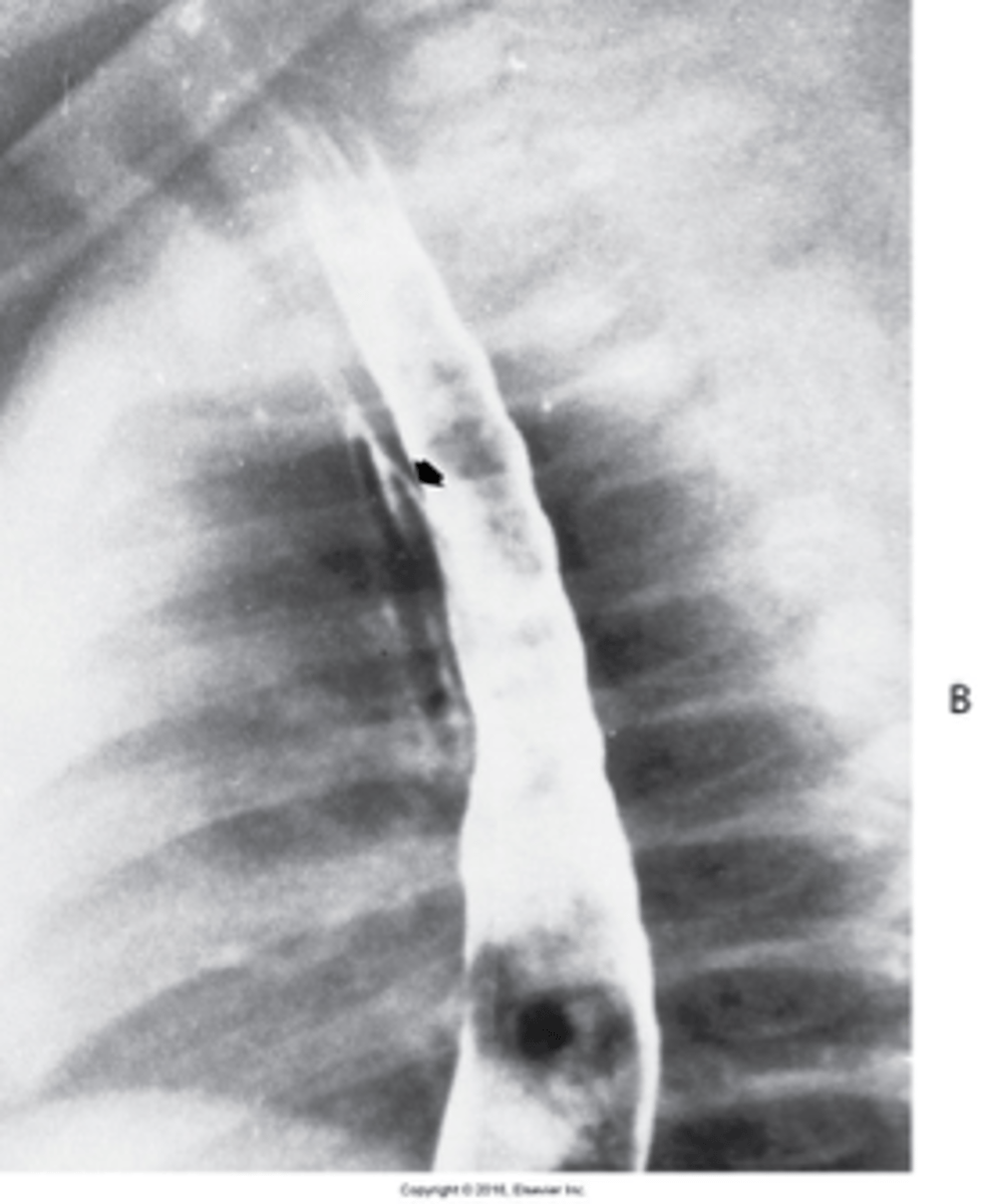 <p>What is Tracheoesophageal Fistula congenita Acquired type ?</p>