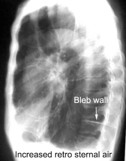 <p>Blebs and Bullae: CXR</p>