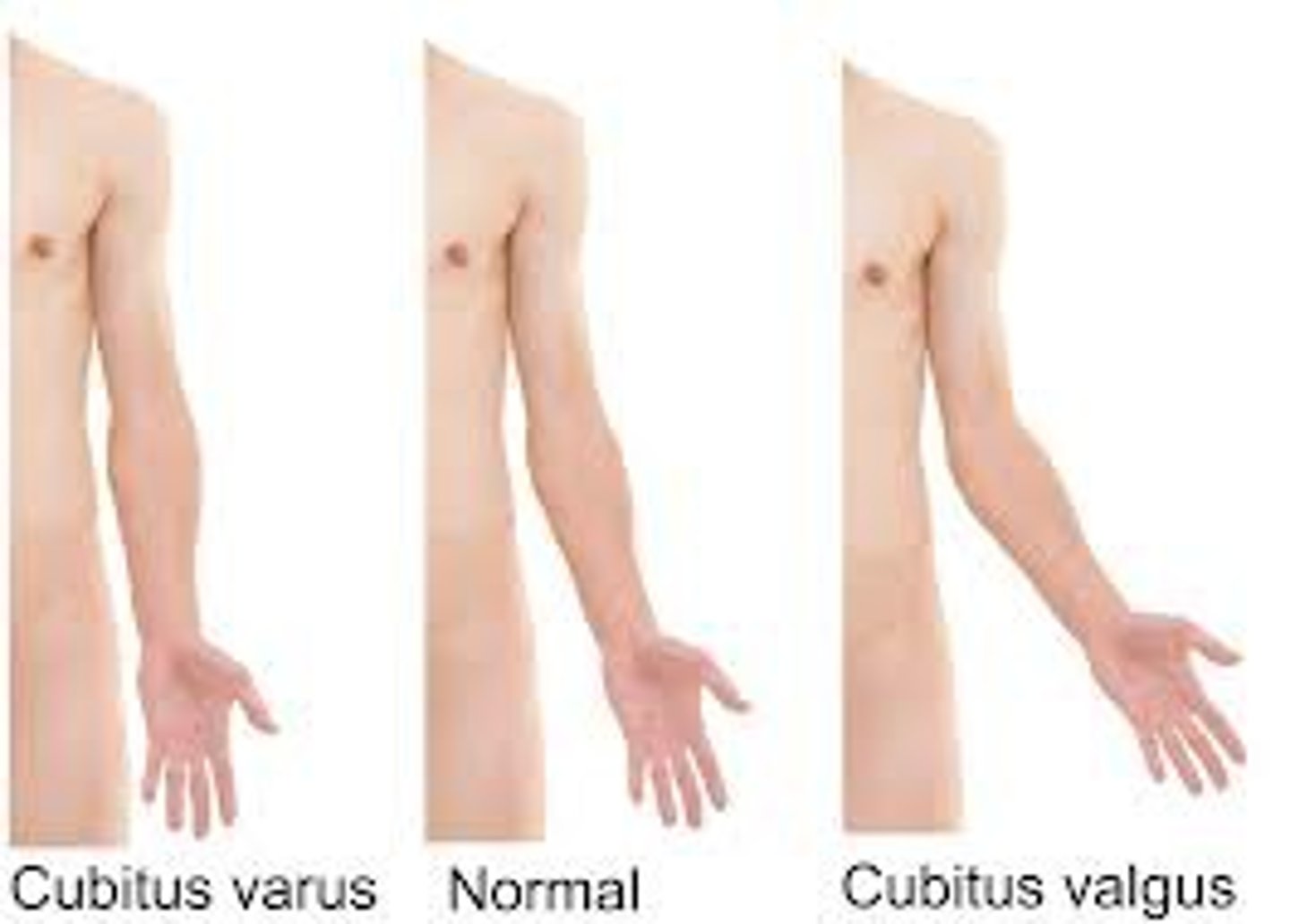 <p>angle of the elbow is exaggerated</p>