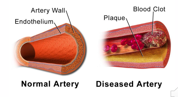 <p>- fibrous cap ruptures -&gt; lipid fragments, cellular debris released into vessel lumen</p><p>- thrombogenic agents -&gt; formation of thrombus</p><p>- thrombus: accumulation of RBCs, platelets (commonly called a clot)</p><p>.</p><p>larger thrombus in:</p><p>- coronary blood vessel --&gt; heart attack</p><p>- cerebral blood vessel --&gt; stroke</p>