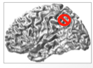 <ul><li><p>deficit in visually guided movements </p></li><li><p>other functions intact (motor, somatosensory, visual acuity)</p></li><li><p>damage to posterior parietal lobe</p></li></ul><p></p>