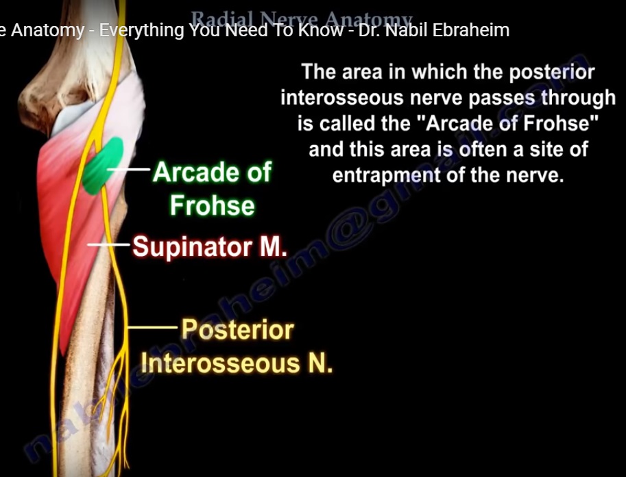 <p>It becomes the *Posterior interosseous nerve (PIN)* — supplies forearm extensors. Mnemonic: "Deep dives → PIN."</p>