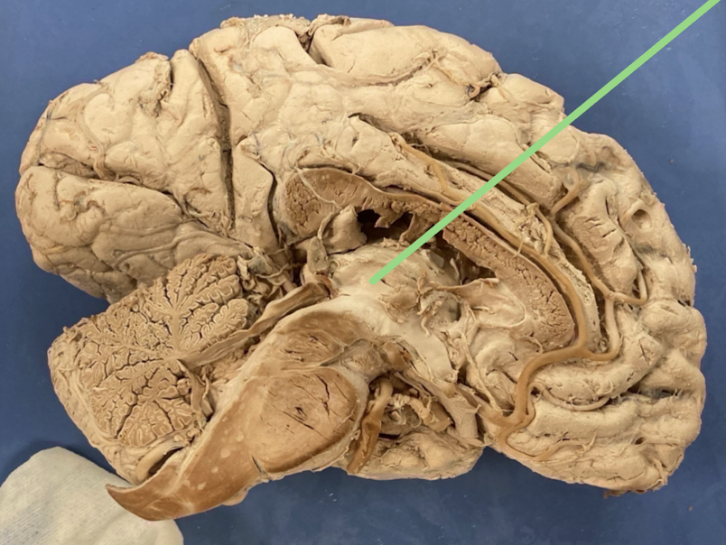 <p>space created by the bilateral lobes of the thalamus when hemispheres are united</p>