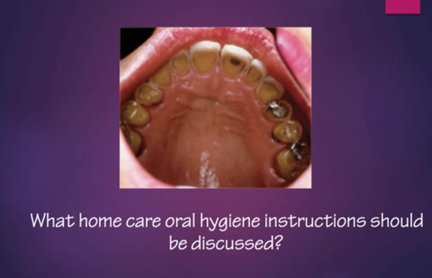 <p>sodium bicarbonate rinse</p>