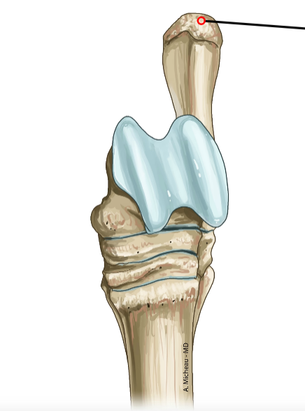 <p>Proximal prominence; insertion of Achilles tendon.</p>