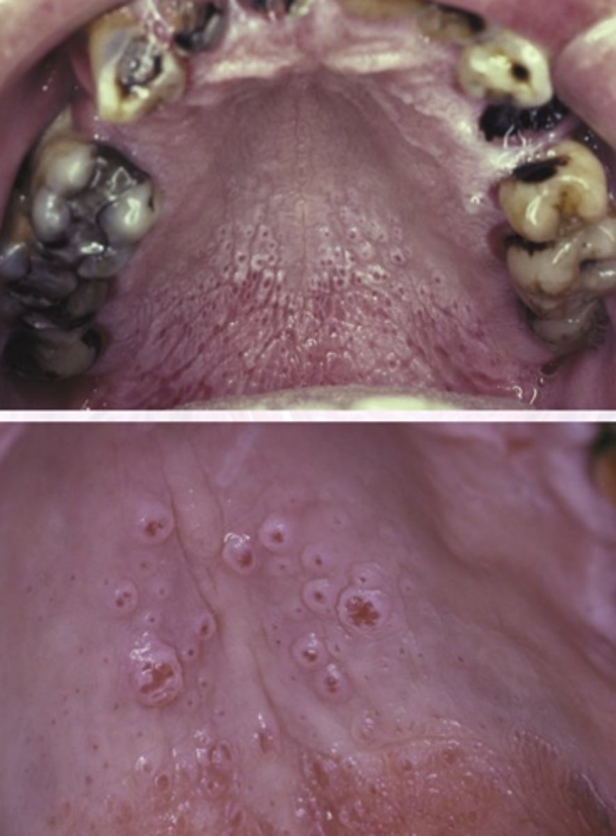 <p>"Dried Mud Appearance"</p><p>Diffuse gray/white mucosa</p><p>Elevates papules with punctate red centers</p><p>inflamed minor salivary glands</p>