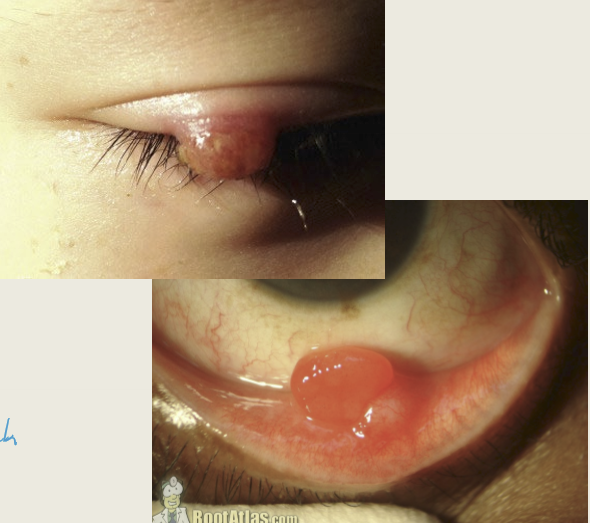<p>Red polypodial lesion that are painful and bleeds easily with minor trauma. It can be a complication of surgery. </p>