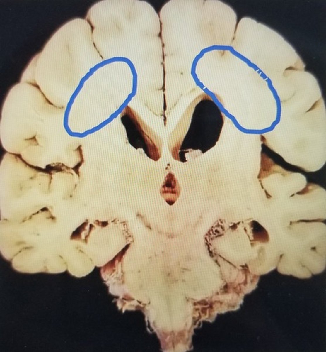 <p>- white matter within cerebrum that funnels axons (ex. corticospinal tract) to internal capsule</p>