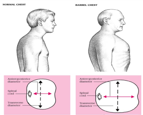 <p>what are the findings indicative of a barrel chest</p>