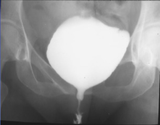 <p>What is this X-ray demonstrating?</p>