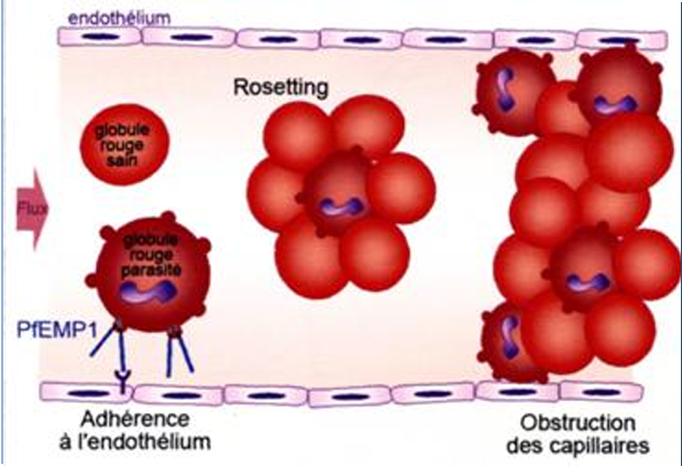 <p>Complication of Pf infection.</p><p>→ Proteins of trophozoite-containing RBCs have receptors (PfEMP) on endothelial cells that result in their adhesion and aggregation of infected and non-infected RBCs (Rosetting) → Obstruction of capillaries</p><p>High TNF: </p><ul><li><p>Fever</p></li><li><p>Confusion, seizures, and coma </p></li><li><p>Metabolic acidosis and RDS6</p></li></ul><p></p>