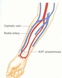 <p>Forearm connecting <strong>radial artery with cephalic vein</strong> at wrist or radiocephalic fistula</p>